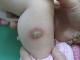 Angeborene Aplasie der Haut (Aplasia cutis congenita)